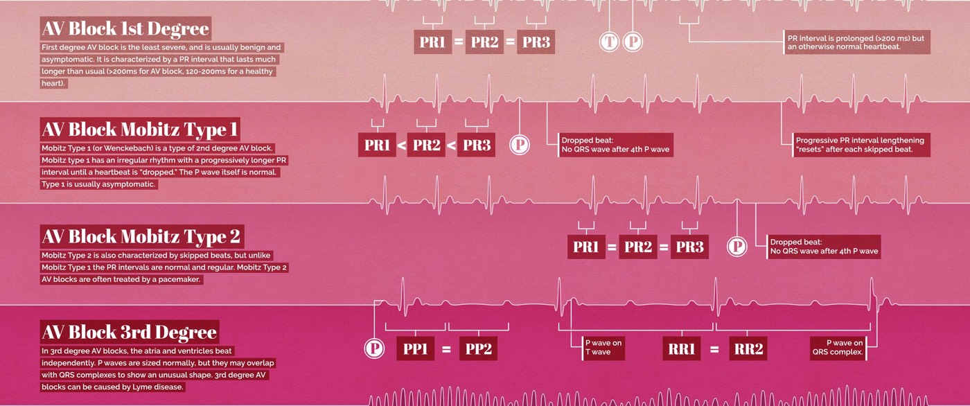 abnormal-heartbeat-ekg-waves