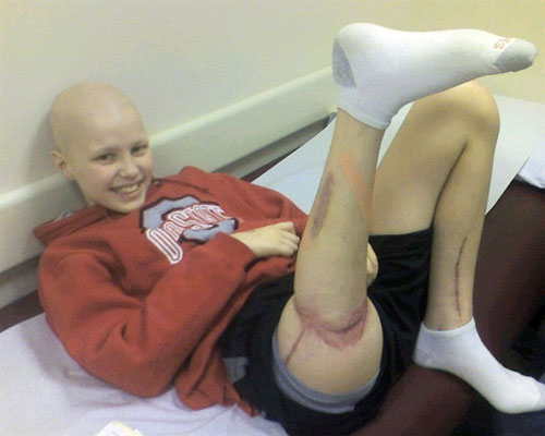 Cancer In Leg
