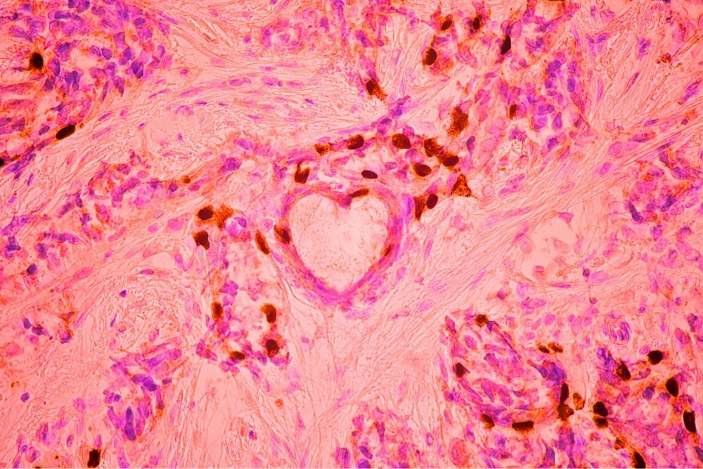 A heart shape is visible amongst breast cancer cells